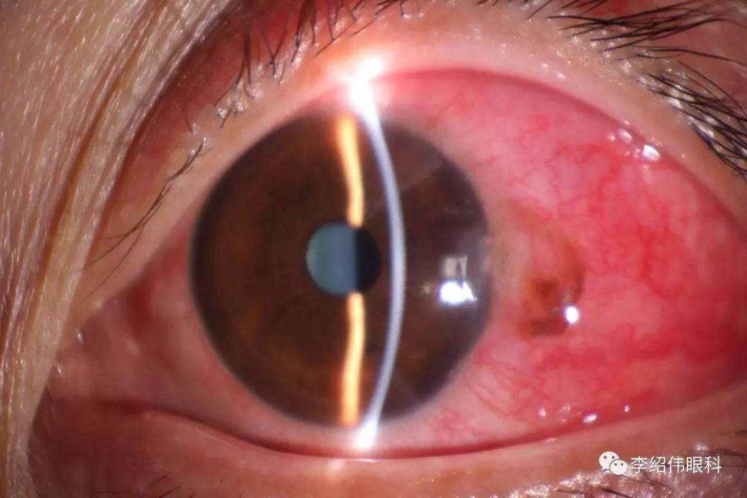 眼睛肿了会是感染新型肺炎了吗,新冠肺炎引起的眼睛红怎么治疗