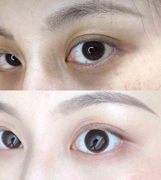 医学博士说眼霜真的治疗黑眼圈吗,真正对黑眼圈有用的眼霜