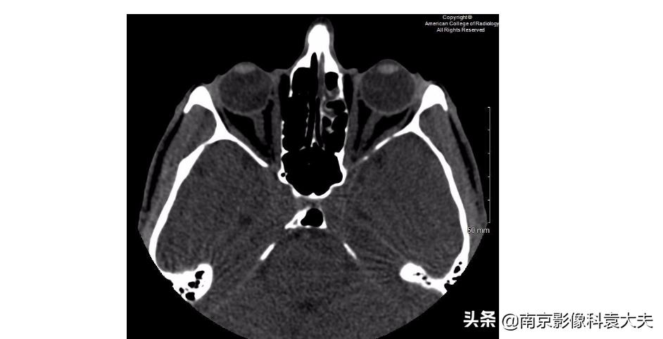 一39岁男子争吵后，右眼突然瞎了，病例分析知答案