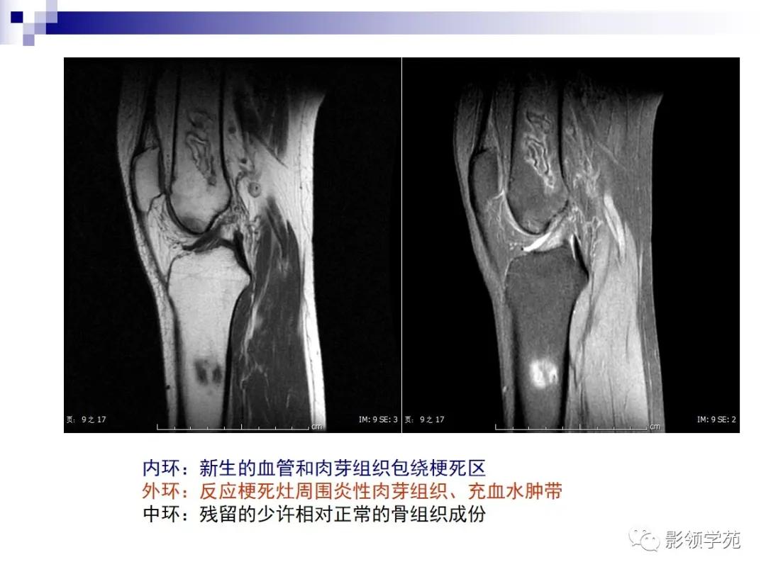 早期骨梗死的ct表现,骨梗死的病理变化