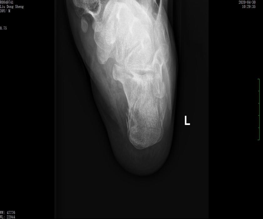 左股骨粗隆间粉碎性骨折微创手术,跟骨粉碎性骨折微创手术最快多久