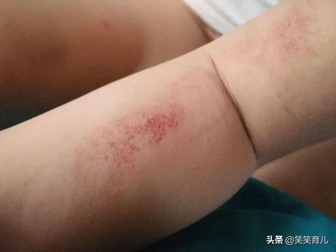 宝宝擦伤怎么处理,宝宝轻度擦伤的正确处理方法