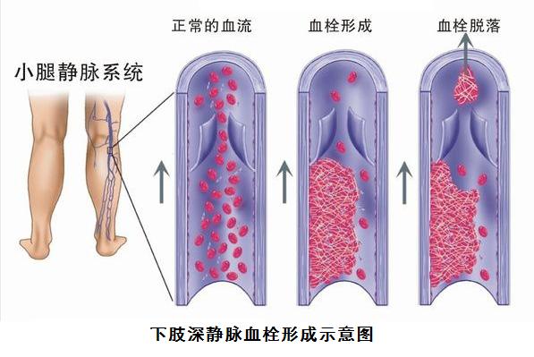 看过来，看过来！静脉曲张与静脉血栓到底有什么区别和联系？