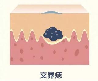 怎么判断是不是兽皮痣,兽皮痣怎么造成的能根治吗