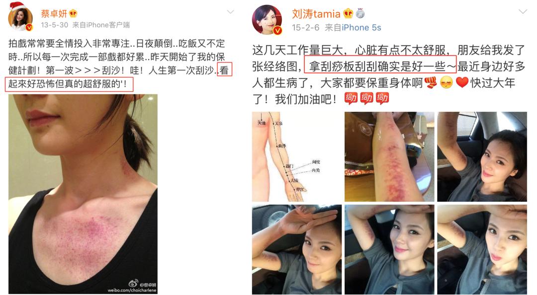 不用火的拔罐器视频,不用火自制拔罐神器