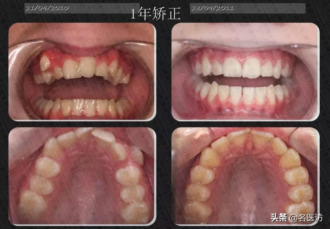 矫正时牙套脸可以去填充吗,戴牙套可以改善脸不对称吗