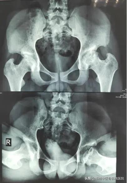 骨坏死中心疑难病例讨论：髋关节的剥脱性骨软骨炎的诊治