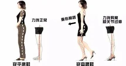 膝超伸腿粗运动可以改善吗,大粗腿膝超伸矫正方法图解