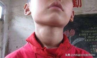 甲亢——轻松就能治好的慢病，李连杰等人却深受其害！