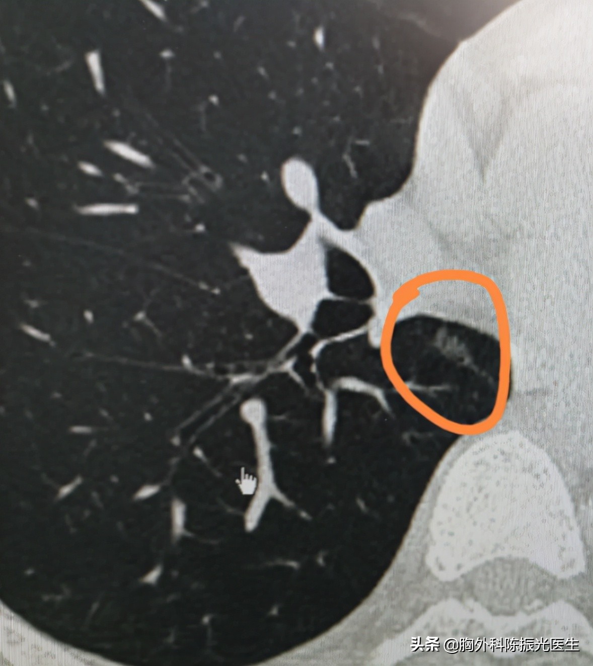 左右两肺背面2枚小结节,右肺上叶尖段1.4厘米是几期肺癌