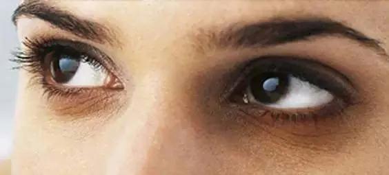 我的黑眼圈完全是熬夜熬出来的,黑眼圈是因为熬夜太多导致的吗