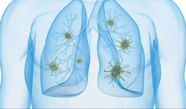 孩子肺炎怎么办最好的办法,小孩肺炎怎么治疗才好得快