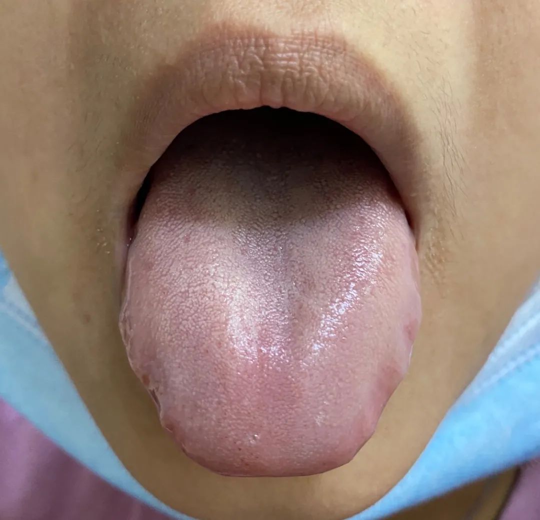 齿痕舌是内湿顽固的标志，教你4个方法，长期坚持消齿印