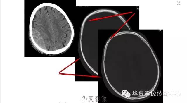 一文读懂颅内胆脂瘤,一文看懂背后的真相