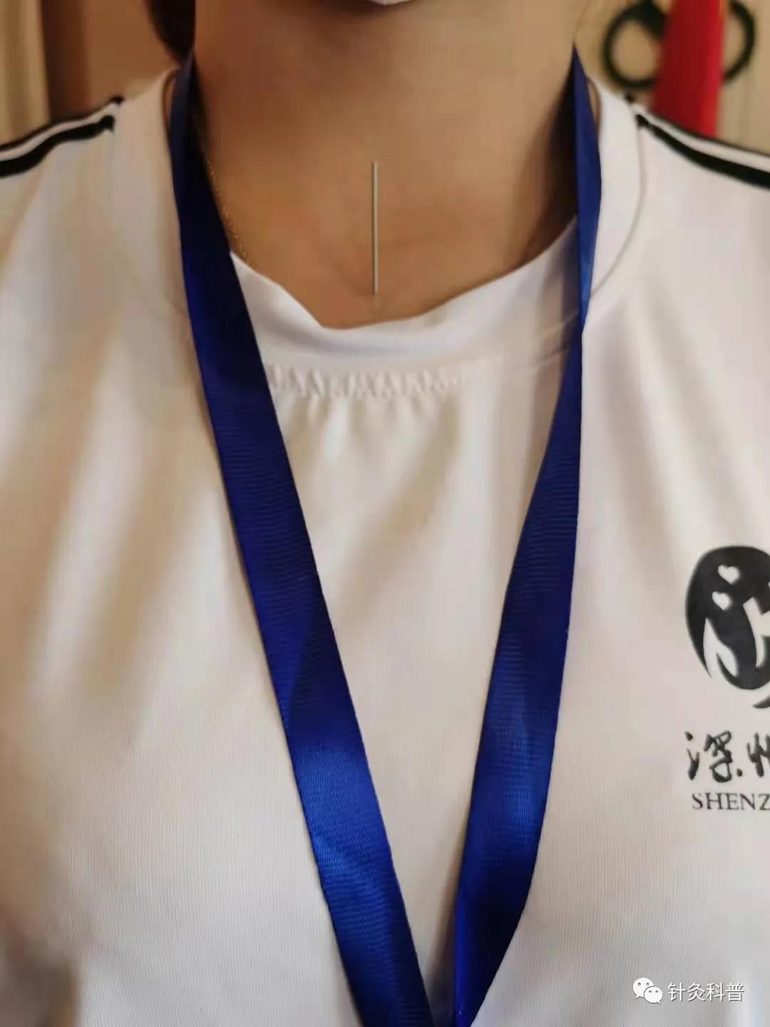 针灸治疗常见疾病方法,伤寒杂病论和针灸