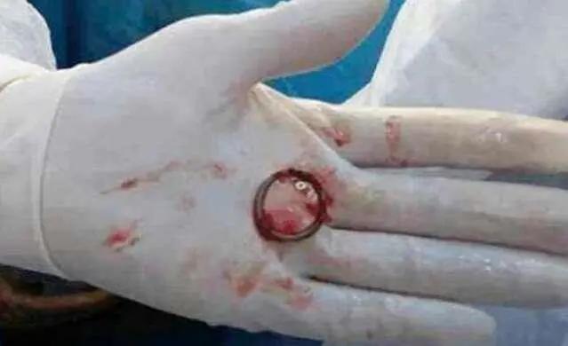 30年前上的避孕环,20年前上的避孕环