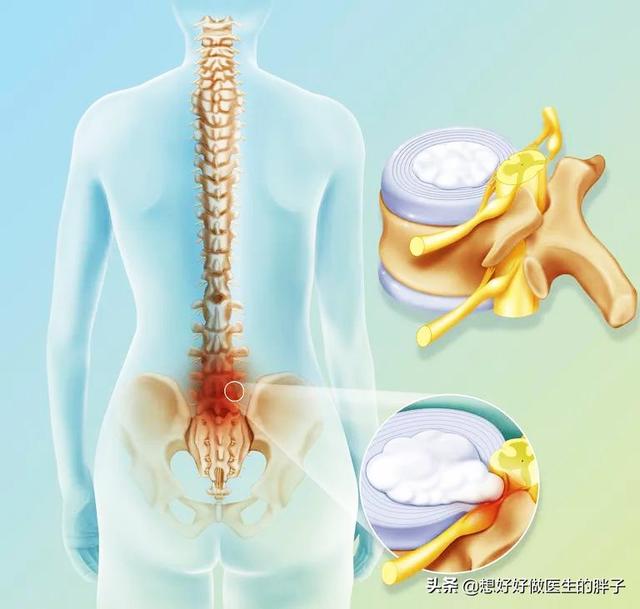 有些患者膝盖疼痛是由腰椎间盘突出压迫神经导致的,千万别忽视