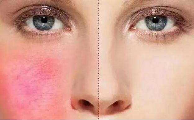 脸上有大面积红血丝怎么遮瑕,一白遮百丑的真实含义