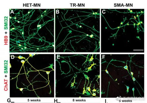 最新临床结果：间充质干细胞有效减缓SMA疾病，显著延长生存期