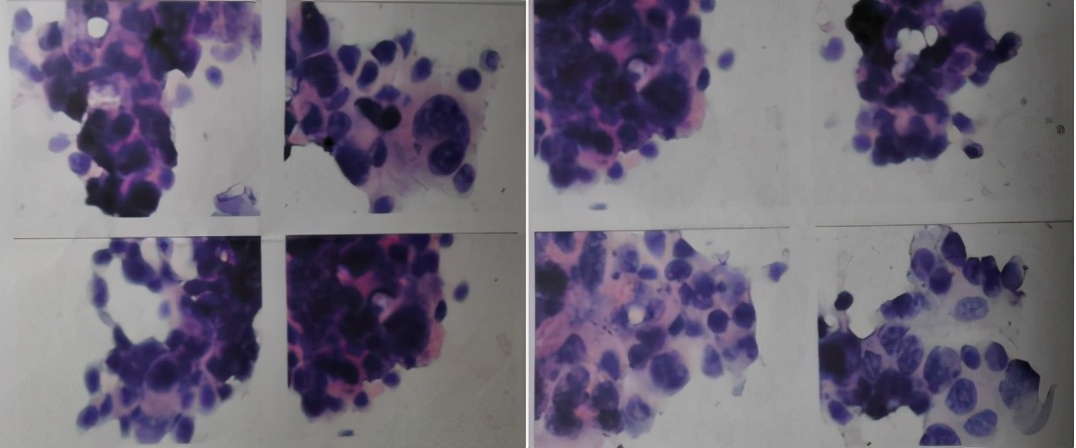 胸腔积液并有顽固性咳嗽,胸腔积液无症状