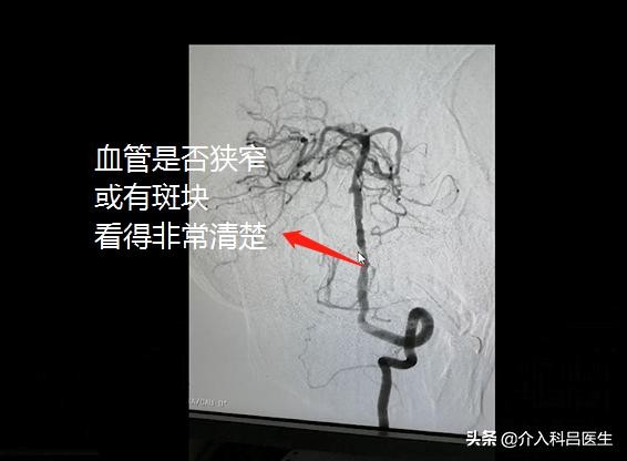 检查心血管必须做造影吗,心血管造影和冠脉造影有区别吗
