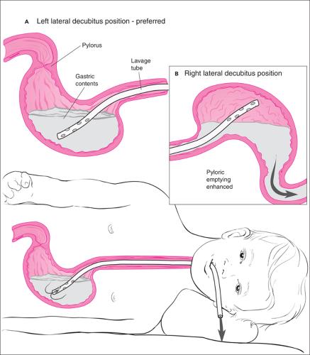 “*眠药安**自杀”没有痛苦？吞下100片*眠药安**后，你的身体会怎么样