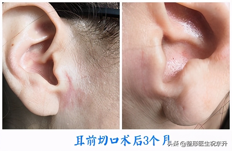 拉皮手术后必须用疤克吗,不做拉皮手术会留疤吗