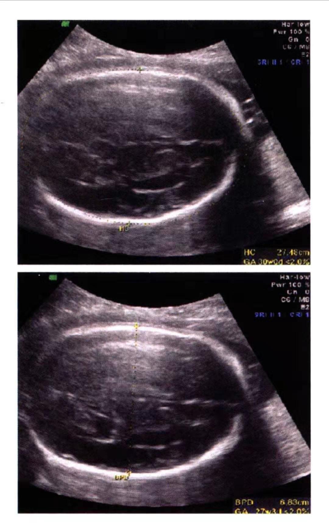 产检医生说胎儿头小,孕期医生说孩子头双顶径有点小