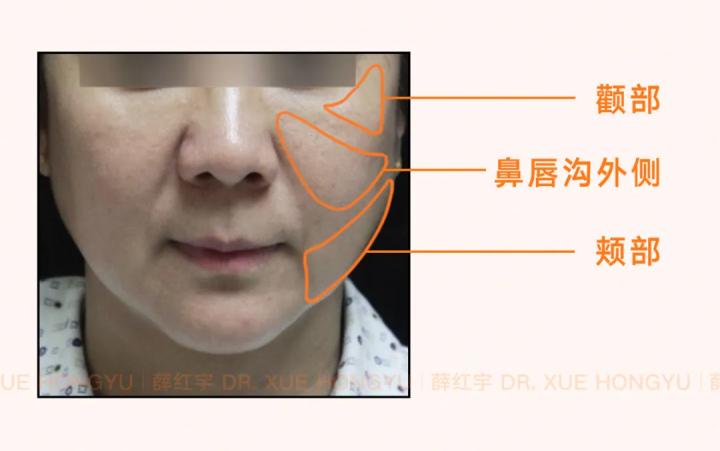 面部吸脂可以瘦脸,面部吸脂全脸什么部位不能吸