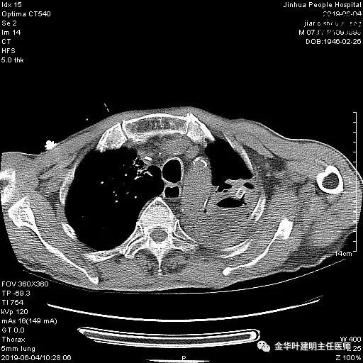 手术引起乳糜胸,有没有做了肺结节手术后是误诊的