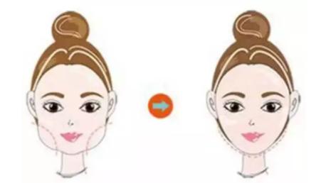 30多岁还能改善下巴后缩吗,30岁还能下颌后缩矫正吗