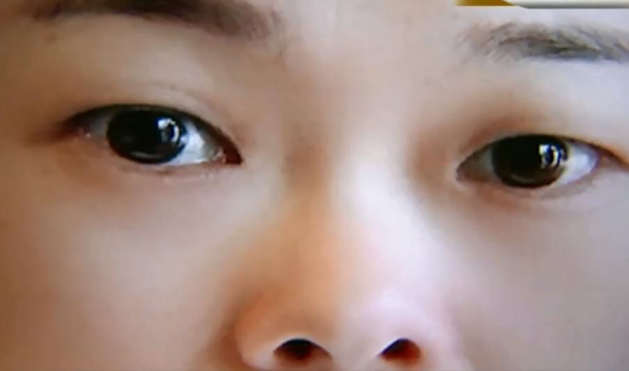 花了三十万割双眼皮河南医院,花了一万五割双眼皮