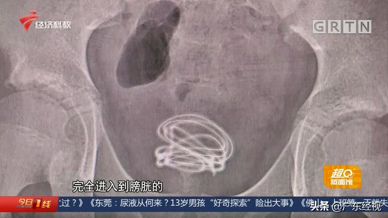 尿液从何来？东莞13岁男孩“好奇探索”险出大事