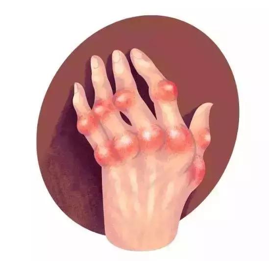 干细胞移植能治好类风湿关节炎吗,类风湿性关节炎最新研究热点