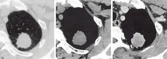 肺癌研究心得,我对癌症患者讲实话