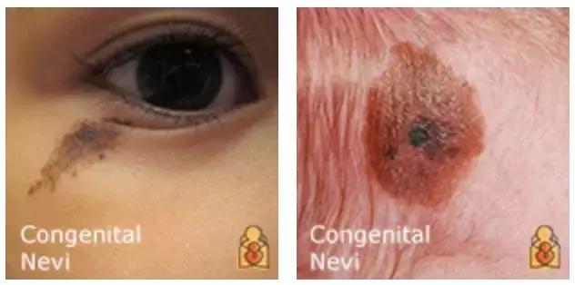 为什么宝宝出生屁股会有青胎记,宝宝出生屁股上有淤青是什么原因