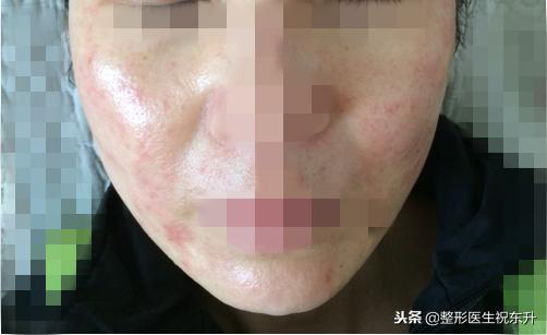 刚做完超声刀感觉脸有点肿正常吗,做完超声刀后脸肿了是正常现象吗