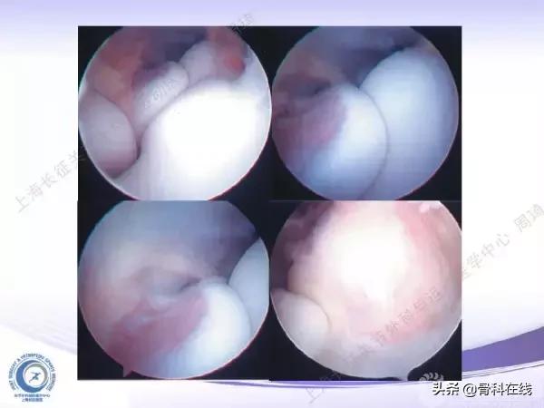 肘关节镜手术后引流,肘关节镜微创手术
