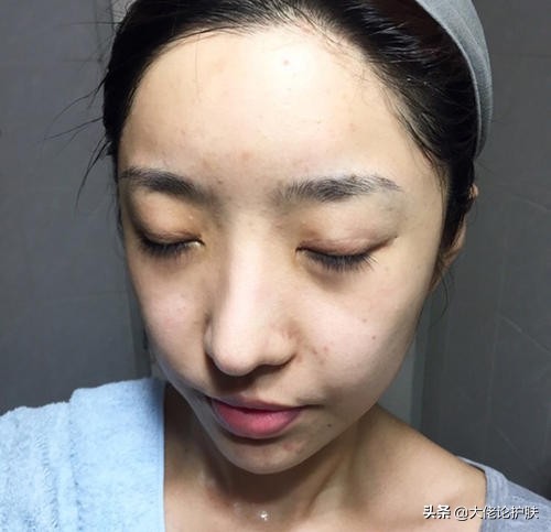 脸上毛囊油脂堵塞毛孔图,毛孔粗大痘痘反复是怎么回事