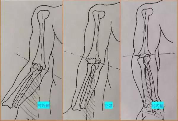 孩子胳膊向外弯怎么回事,小孩胳膊肘往内拐什么原因