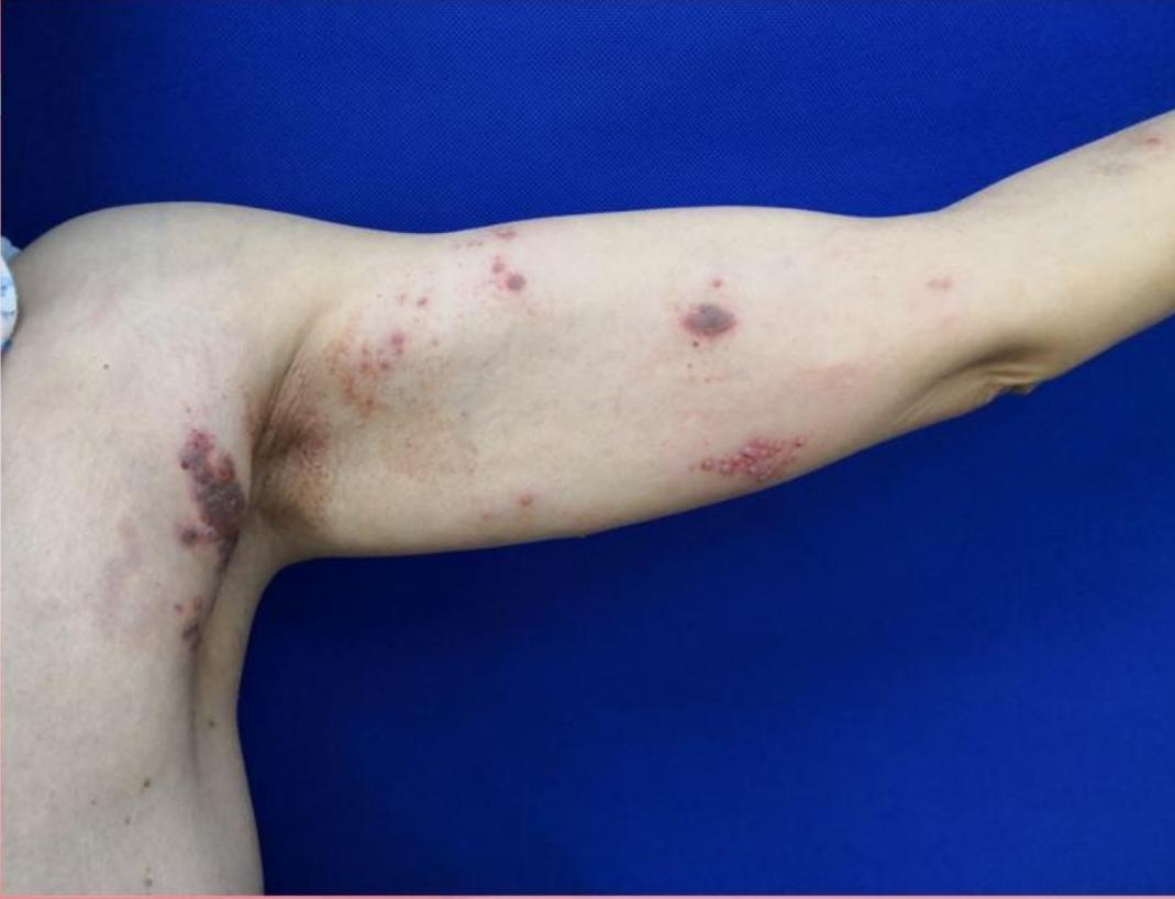 民间所谓的生蛇是什么病,民间说生蛇什么意思