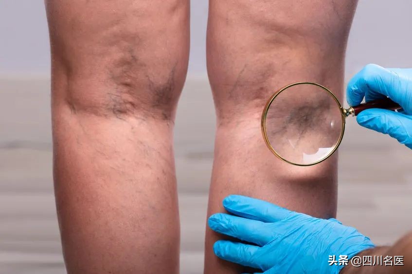 华西专家讲静脉曲张,16岁少年得静脉曲张吗