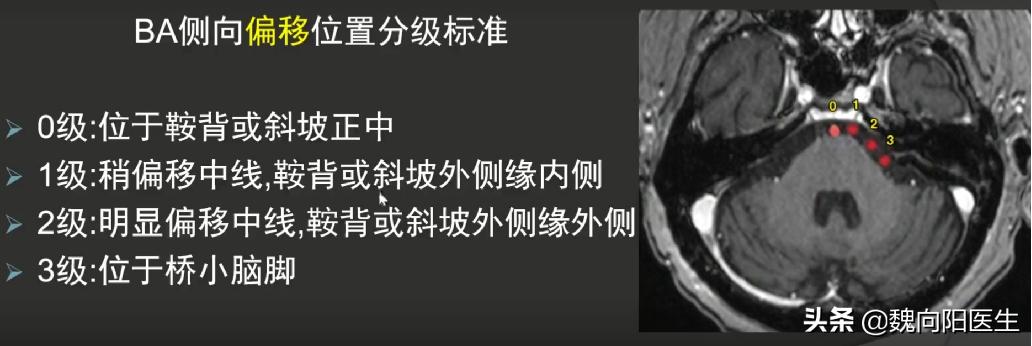 耳眩晕是什么疾病,眩晕常见疾病之梅尼埃