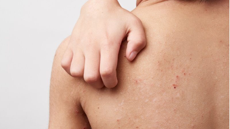 育儿百科|宝宝长痱子擦什么好