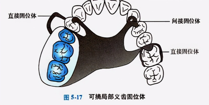 牙列缺损的可摘局部义齿修复题库,牙科美学修复精讲