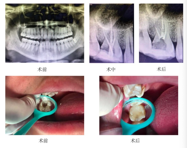 牙痛不能忽视,这类牙疼要警惕
