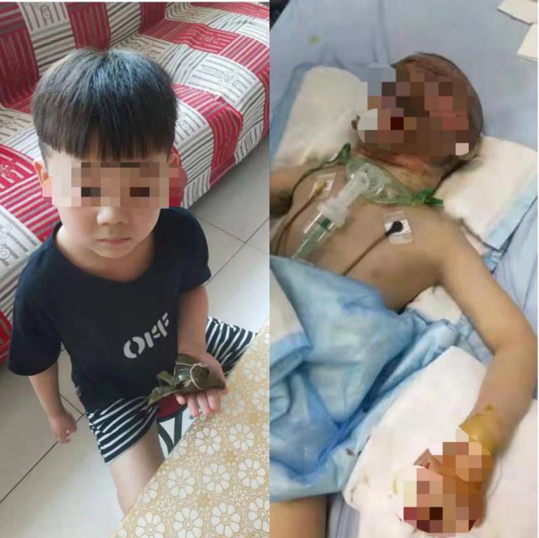 为救太奶奶被火烧伤毁容的小男孩,为救太奶奶被烧伤后续