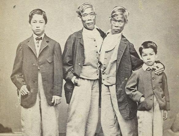 连体人是如何结婚生子呢,连体人结婚生了孩子是什么样子