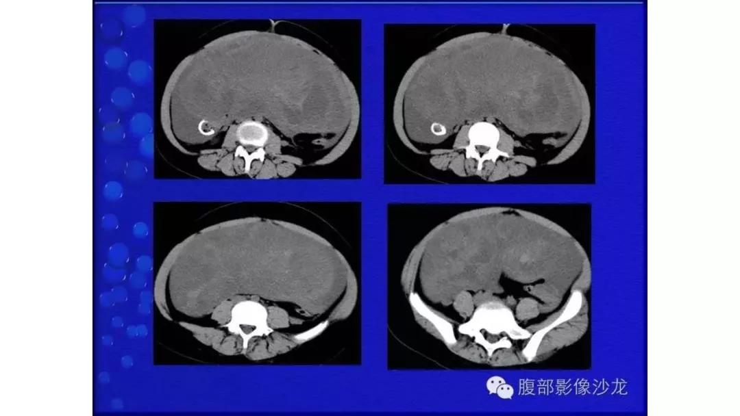 卵巢原发肿瘤的分析思路