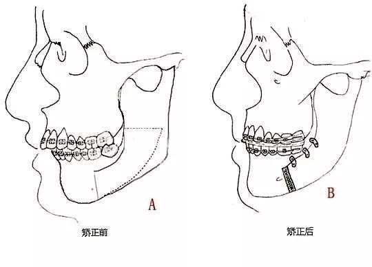 正畸日记补牙,正畸刚戴上牙套的不适应有哪些